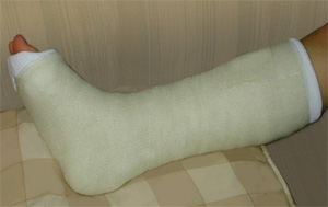 Leg bandaged in a tight dressing, plaster cast for fracture of the