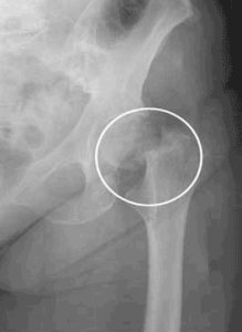 Left Hip Fracture