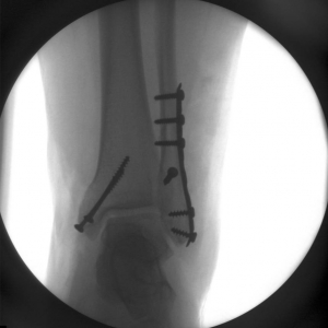 Fixed Ankle Fracture