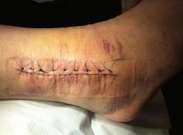 http://myorthoclinic.com/wp-content/uploads/2013/07/sutures-in-situ.jpg