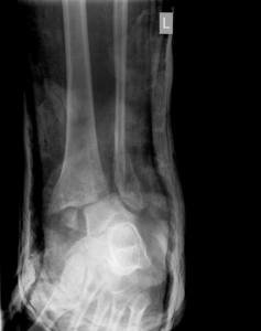 X-ray of a dislocated and fractured ankle with a plaster cast surrounding it. 